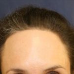 Hair Restoration Before & After Patient #5825