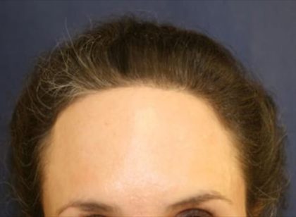 Hair Restoration Before & After Patient #5825