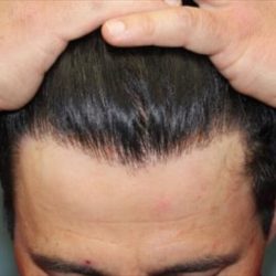 Hair Restoration Before & After Patient #5742
