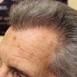 Hair Restoration Before & After Patient #5745