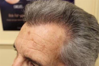 Hair Restoration Before & After Patient #5745