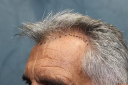Hair Restoration Before & After Patient #5745