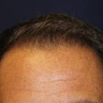 Hair Restoration Before & After Patient #5752