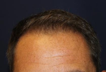 Hair Restoration Before & After Patient #5752