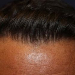 Hair Restoration Before & After Patient #5752