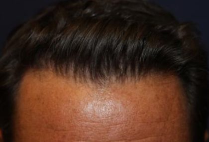 Hair Restoration Before & After Patient #5752