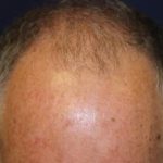 Hair Restoration Before & After Patient #5755