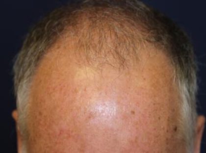 Hair Restoration Before & After Patient #5755