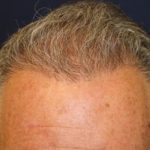 Hair Restoration Before & After Patient #5755