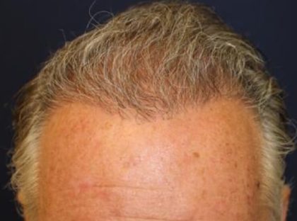 Hair Restoration Before & After Patient #5755