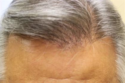 Hair Restoration Before & After Patient #5868