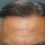 Hair Restoration Before & After Patient #5868