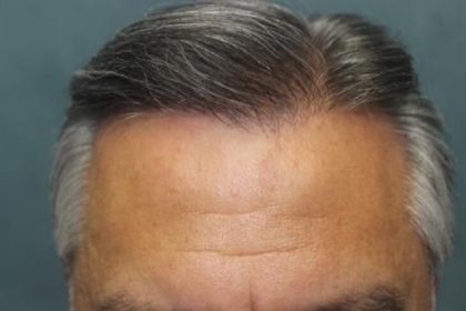 Hair Restoration Before & After Patient #5868