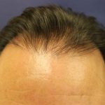 Hair Restoration Before & After Patient #5828