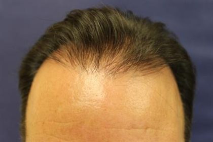 Hair Restoration Before & After Patient #5828