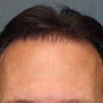 Hair Restoration Before & After Patient #5828