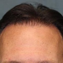 Hair Restoration Before & After Patient #5828