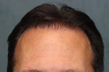 Hair Restoration Before & After Patient #5828