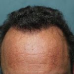 Hair Restoration Before & After Patient #5835