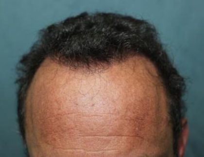 Hair Restoration Before & After Patient #5835