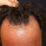 Hair Restoration Before & After Patient #5835