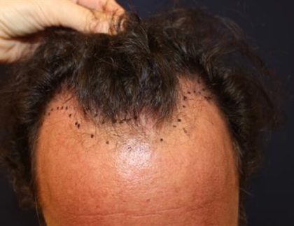 Hair Restoration Before & After Patient #5835