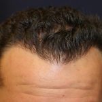 Hair Restoration Before & After Patient #5758