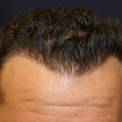 Hair Restoration Before & After Patient #5758