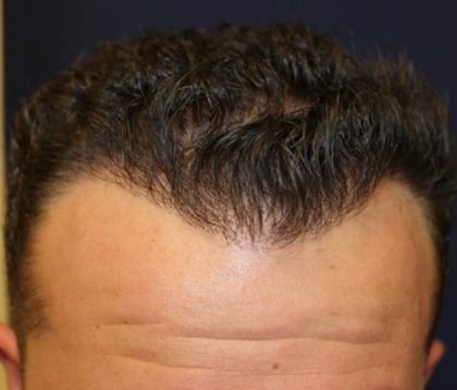 Hair Restoration Before & After Patient #5758