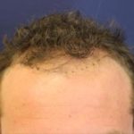 Hair Restoration Before & After Patient #5758