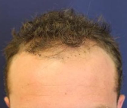 Hair Restoration Before & After Patient #5758