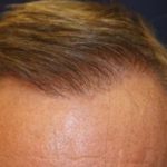 Hair Restoration Before & After Patient #5761