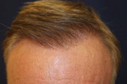 Hair Restoration Before & After Patient #5761