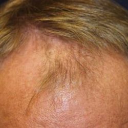 Hair Restoration Before & After Patient #5761