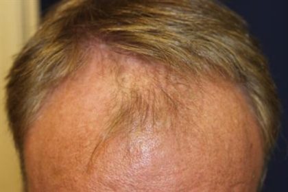 Hair Restoration Before & After Patient #5761