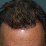 Hair Restoration Before & After Patient #5832