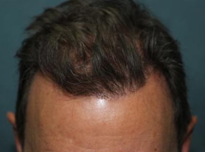 Hair Restoration Before & After Patient #5832