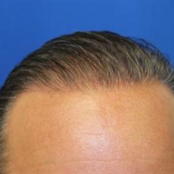 Hair Restoration Before & After Patient #5764
