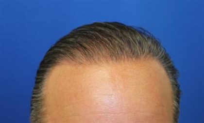 Hair Restoration Before & After Patient #5764