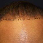 Hair Restoration Before & After Patient #5764