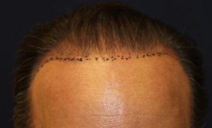 Hair Restoration Before & After Patient #5764