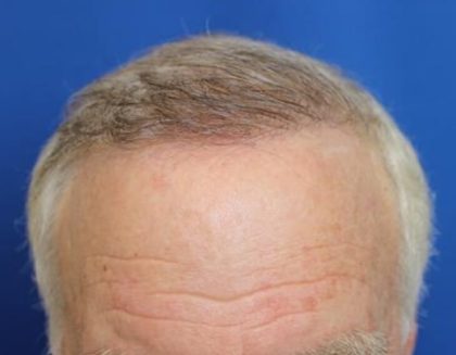 Hair Restoration Before & After Patient #5773