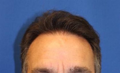 Hair Restoration Before & After Patient #5871