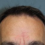 Hair Restoration Before & After Patient #5871