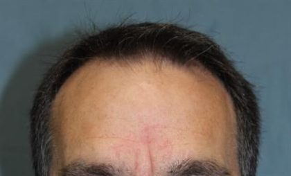 Hair Restoration Before & After Patient #5871