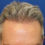 Hair Restoration Before & After Patient #5845