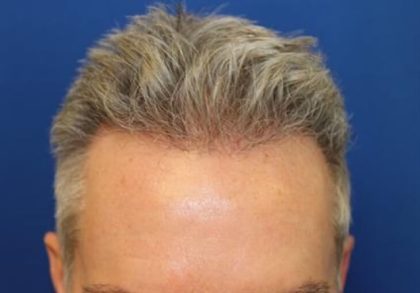 Hair Restoration Before & After Patient #5845