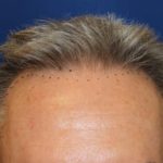 Hair Restoration Before & After Patient #5845