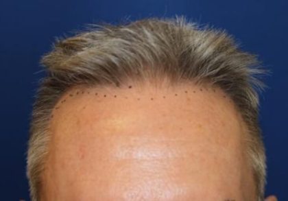 Hair Restoration Before & After Patient #5845