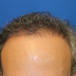 Hair Restoration Before & After Patient #5774